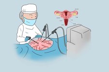 子宫切除是否影响试管婴儿？